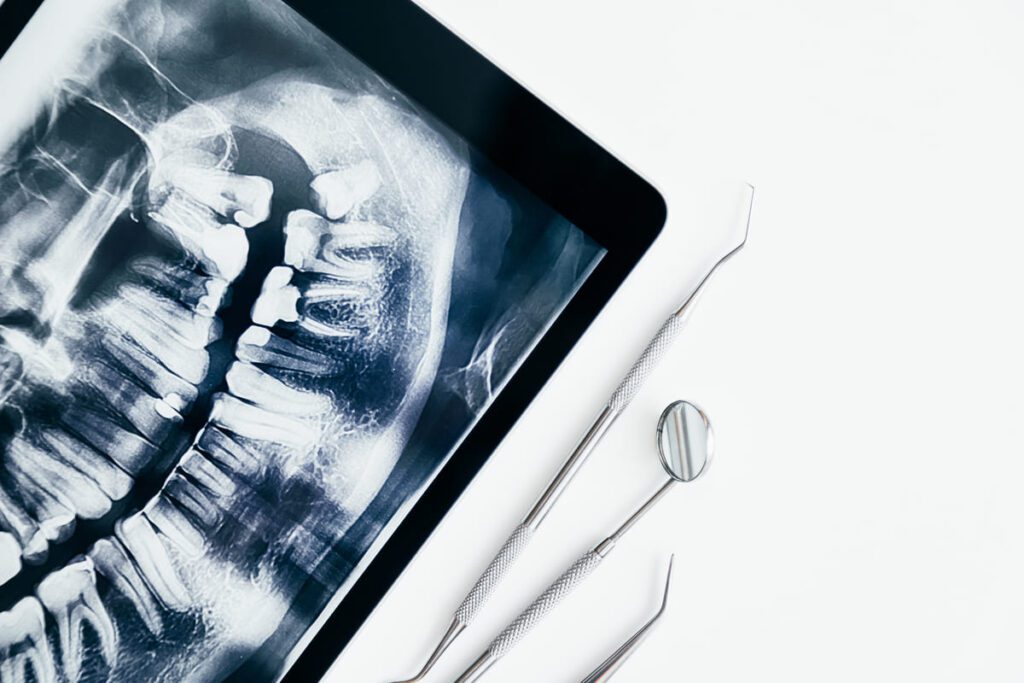 Cómo interpretar las radiografías dentales Enfermedades periodontales