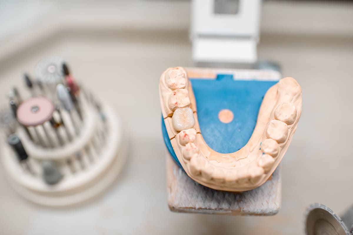 Imagen destacada de “Cómo mejorar la salud bucodental en pacientes con prótesis dentales”