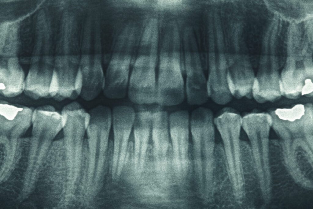 Interpretando las radiografías dentales: Caries