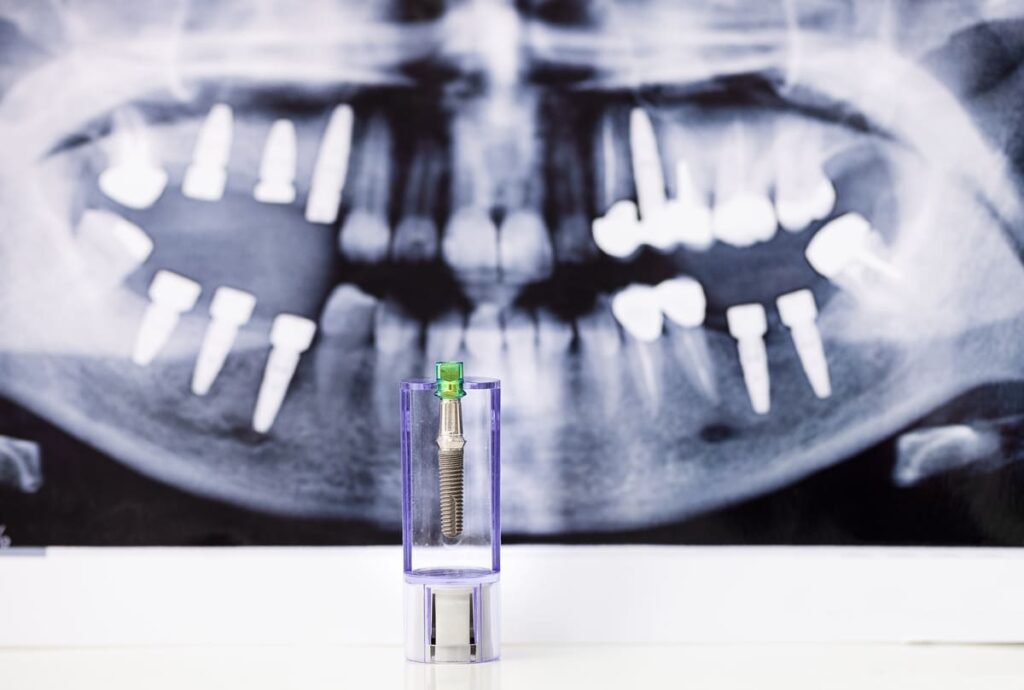 Cómo interpretar las radiografías dentales Implantes dentales