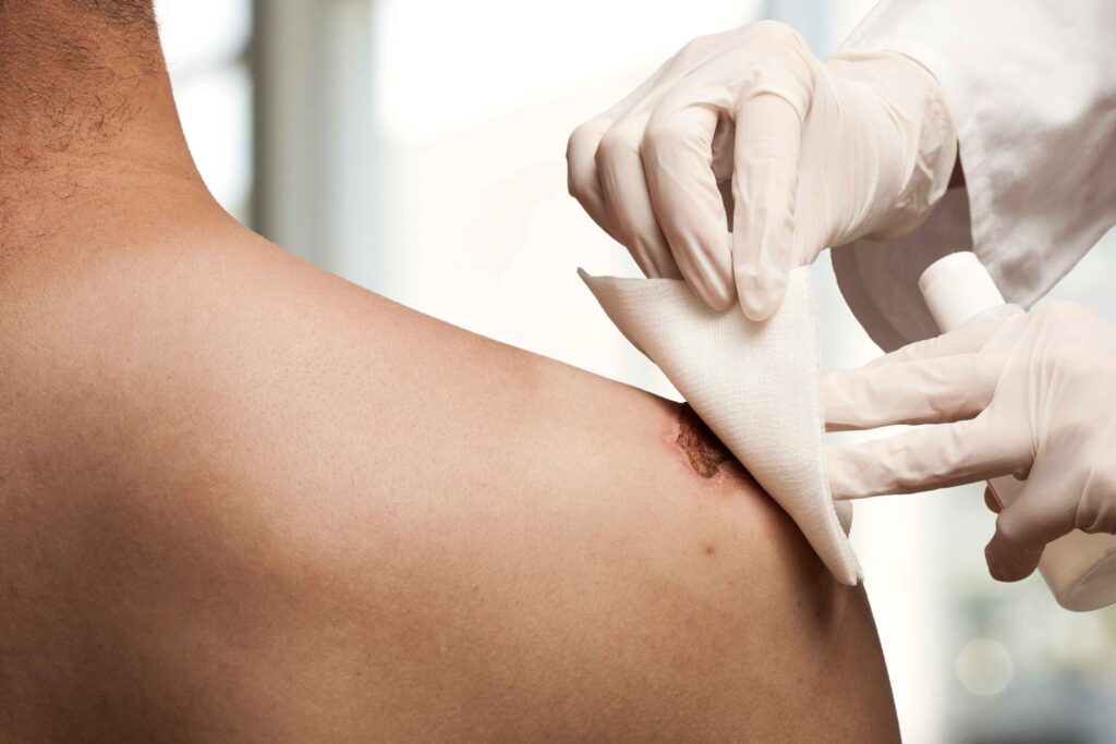 Cuidados esenciales en pacientes con úlceras por presión