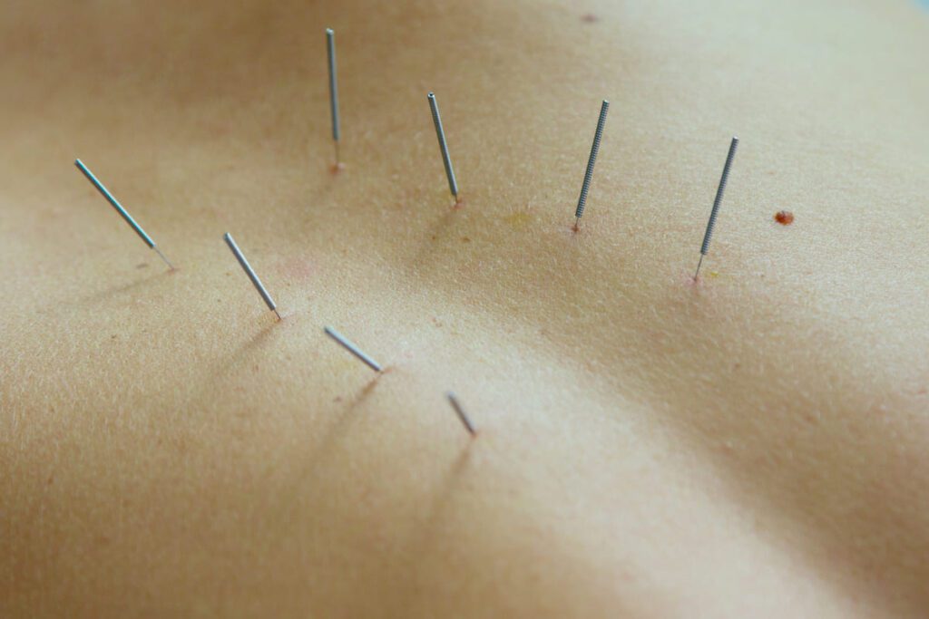 Acupuntura en fisioterapia: Dolor musculoesquelético