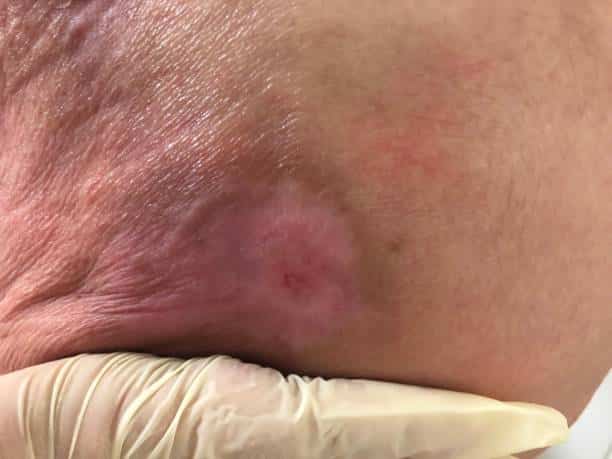 Fases de las úlceras por presión