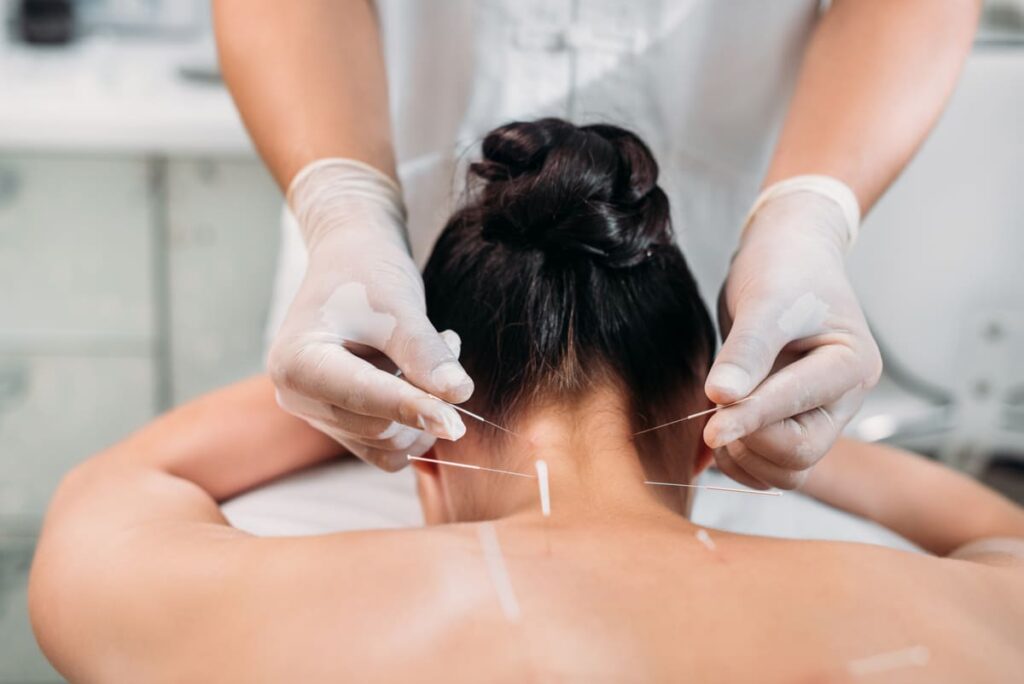 Integración de la acupuntura en la práctica fisioterapéutica